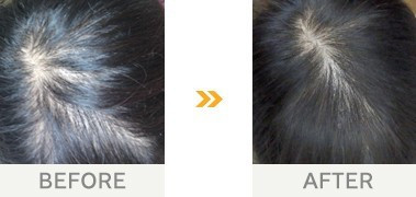 改善事例 頭頂部を見られる事に抵抗はなくなりました 育毛シャンプー 育毛剤ルチア