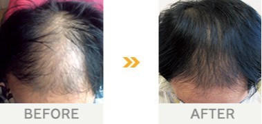男性の薄毛改善事例・30歳男性・3年2ヶ月