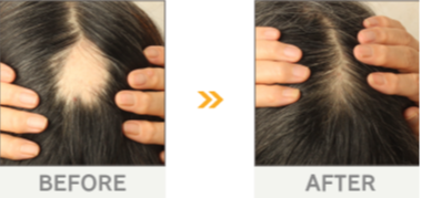 額の薄毛・円形脱毛の改善事例