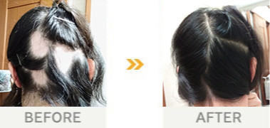 円形脱毛の改善事例