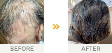 ルチアの育毛を信じて 乗り越えることが出来た 