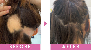 円形脱毛　改善事例