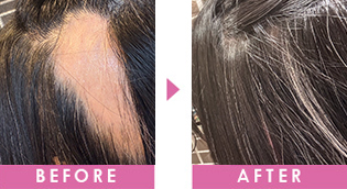 円形脱毛　改善事例