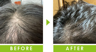 頭頂部の薄毛　育毛事例