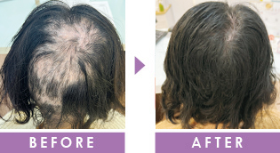 悪化した薄毛　育毛事例