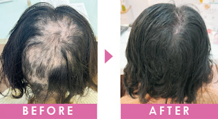 円形脱毛　改善事例