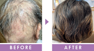 悪化した薄毛　育毛事例